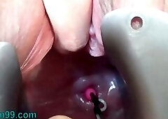 Insertion of Semen with Syringe into Uterus